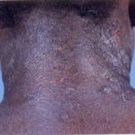 eczema of neck